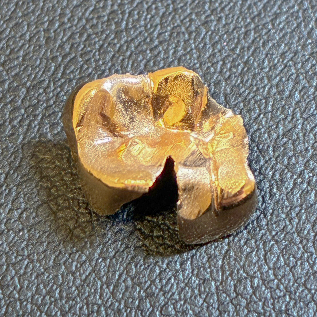 金歯のお買取をさせていただきました！